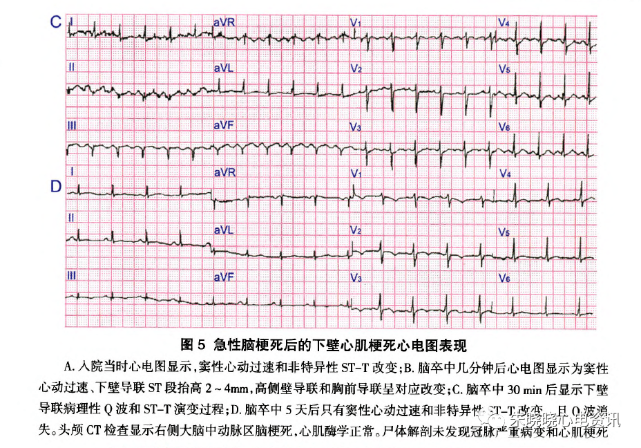 脑卒中几分钟后心电图显示为窦性心动过速,下壁导联st段抬高2～4mm,高