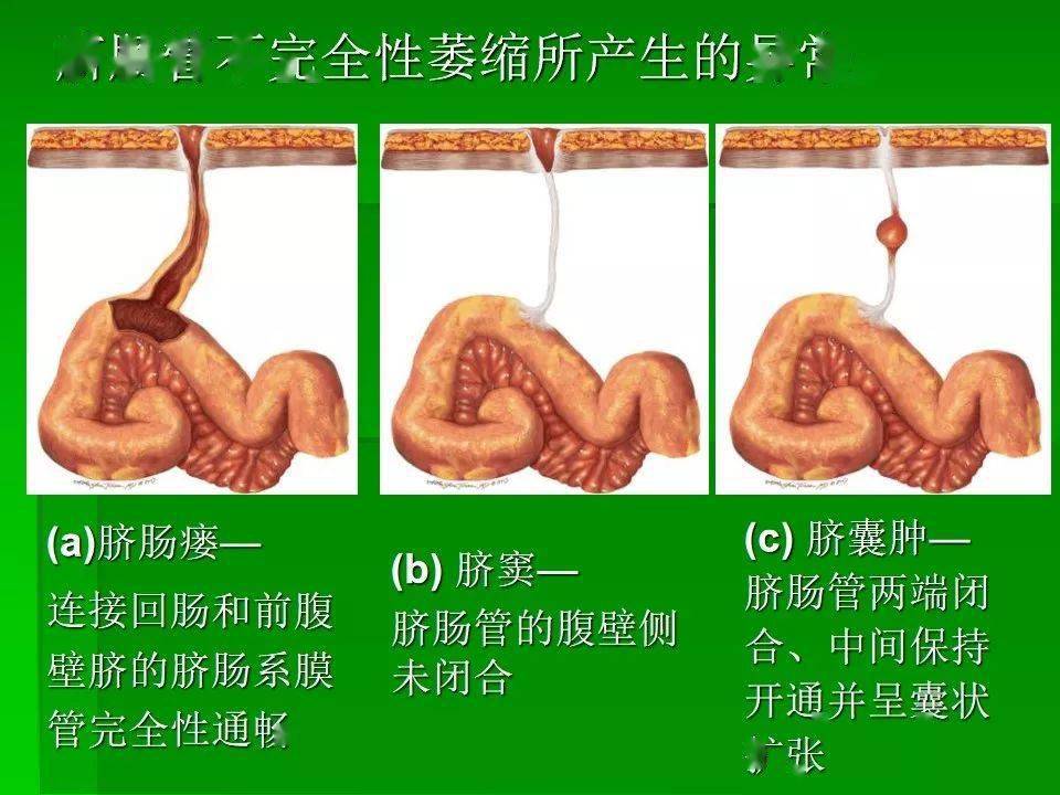 梅克尔憩室综述