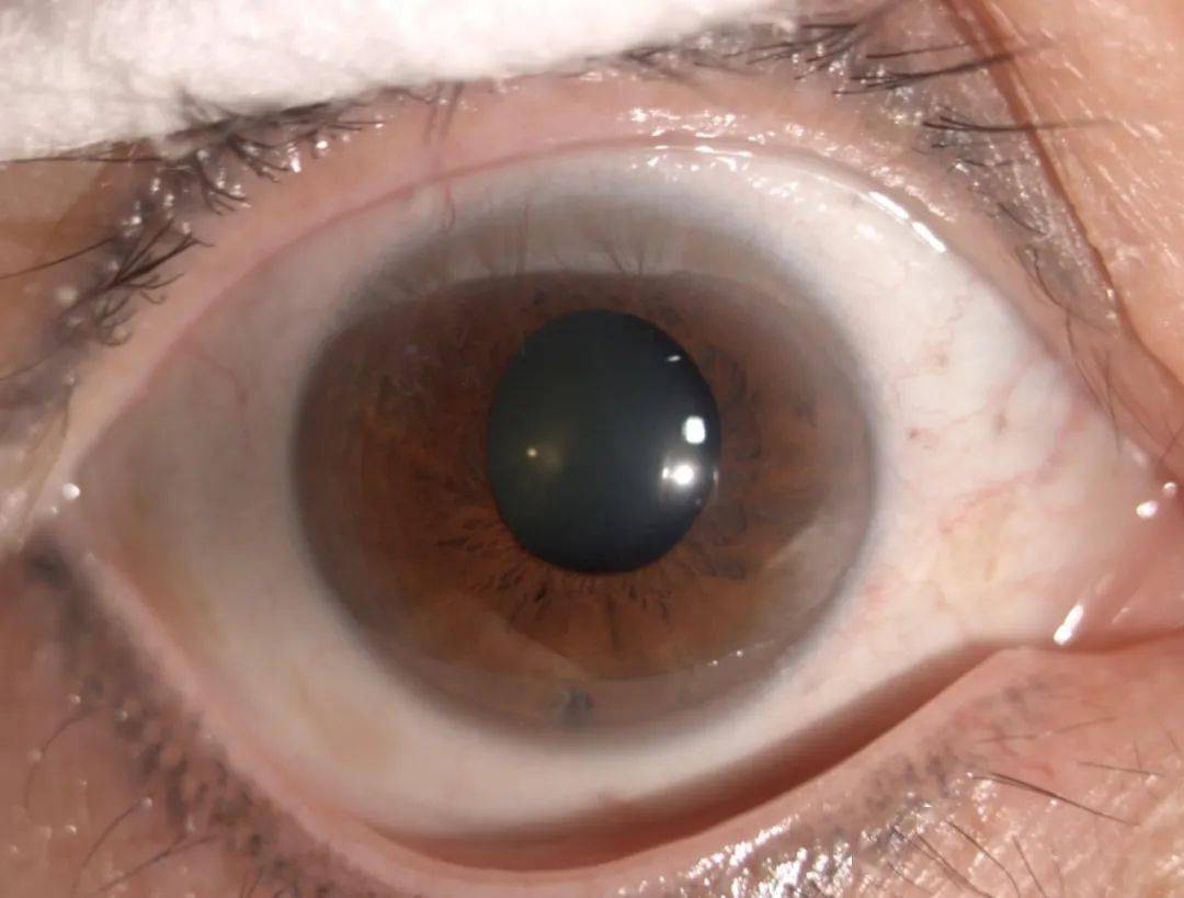 眼科怎么检查白内障 e42aa5d81b0d410ba546a83266f897f2.jpeg