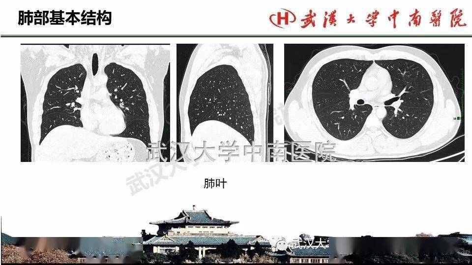 肺部影像解剖及基本概念,基本病变