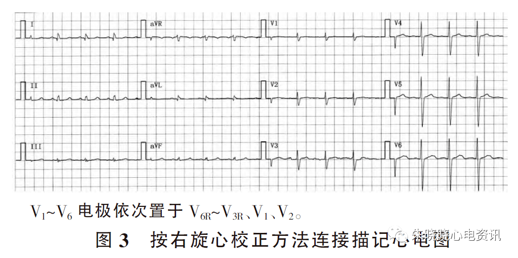 右旋心心电图特征及意义