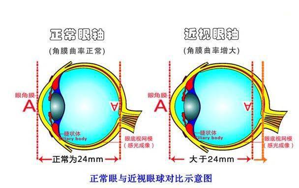 如何正确理解"裸眼视力"和"屈光度"的关系?