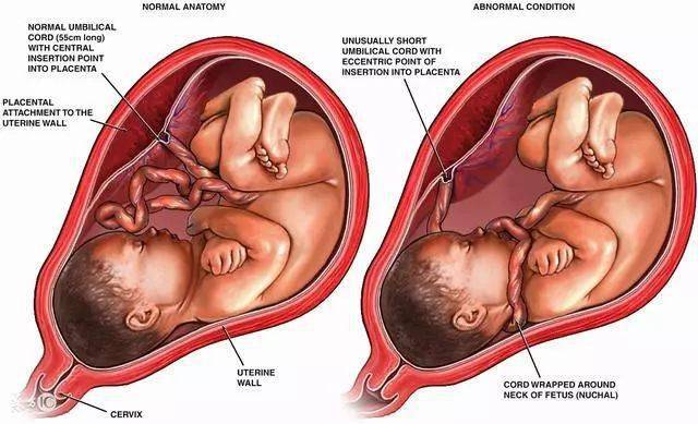 胎儿|孕期，这4个常见的坏习惯，最容易造成胎儿脐带绕颈
