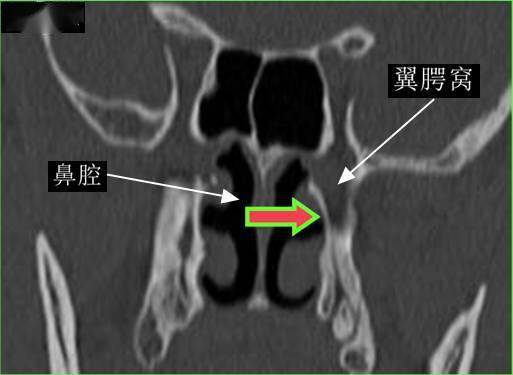 破裂孔后上:圆孔---颅中窝后下:腭鞘管---鼻咽内:蝶腭孔---鼻腔外