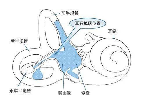 天旋地转耳石症