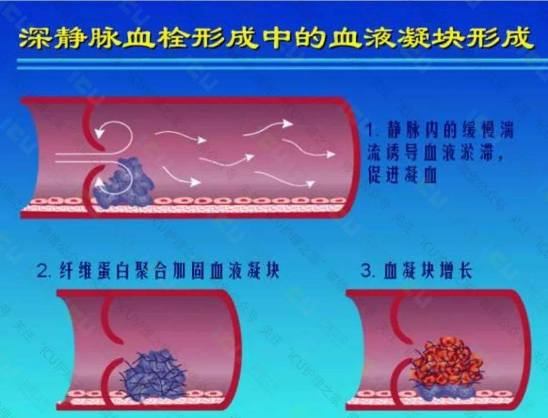 是引起静脉血栓的基本因素之一,各种大型手术可引起高凝状和血小板黏