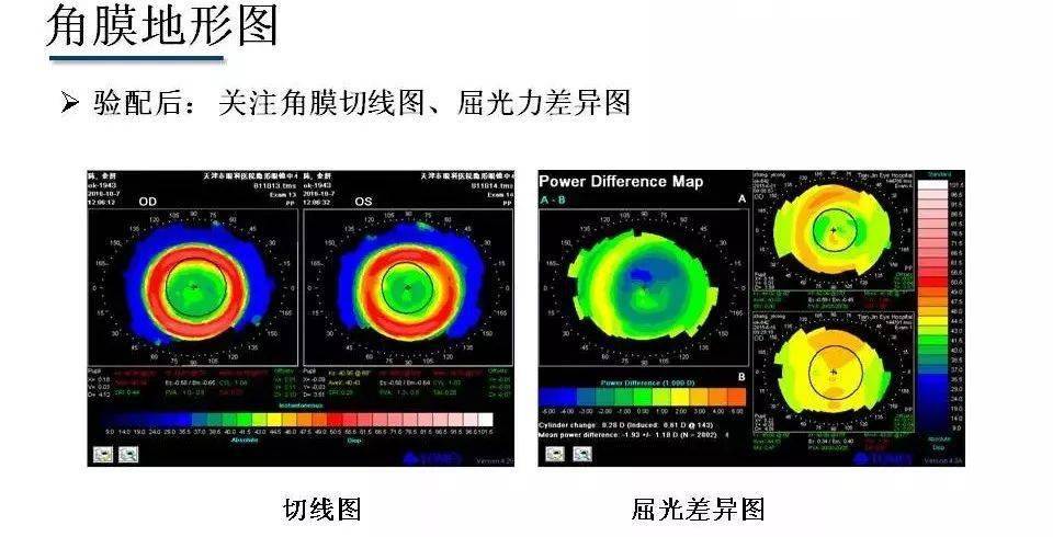 视光相关检查 电脑验光  角膜曲率 主观验光 视功能检查 角膜地形图