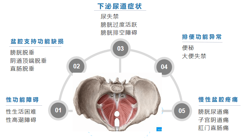 女性盆底解剖简图 盆底疾病是什么 盆底支持组织因退化,损伤所致松弛