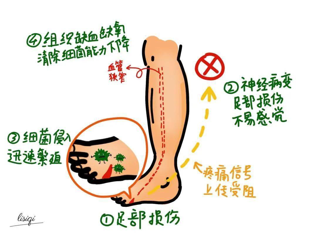 【科普】糖尿病足