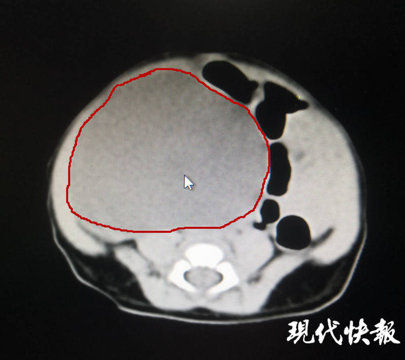 新生|产检时就发现了新生宝宝患卵巢囊肿