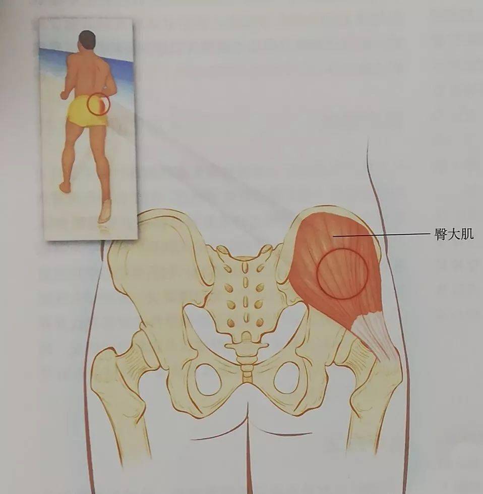 疼痛主要位于臀大肌的内侧和靠下方的位置,即越过臀部牵涉到尾骨区域