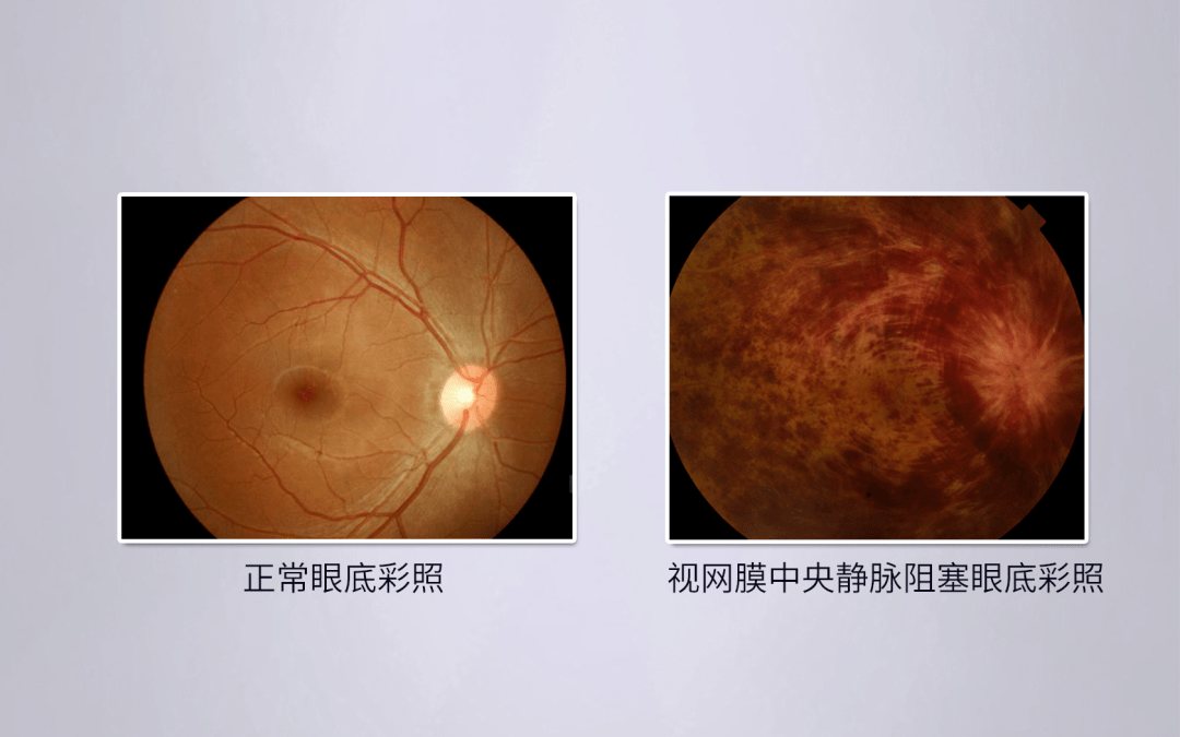 (二)视网膜动脉阻塞也被称为"眼中风",主要表现为突发性的一侧视力