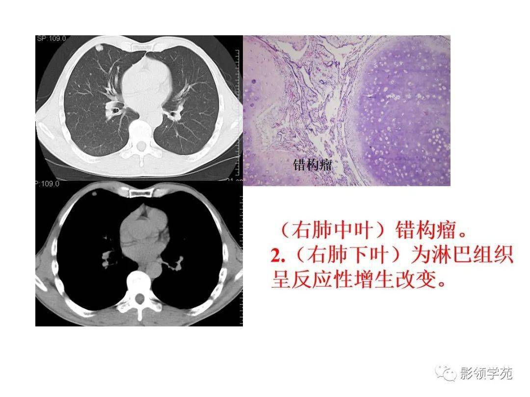 怎么看自己是什么类型肺结核 032d0a10406e4e2abb83a3df9a5ce123.jpeg