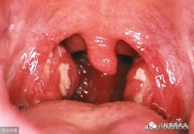 方法2:按扁桃体占据口咽宽度分度: 根据口咽部通道的宽窄程度把