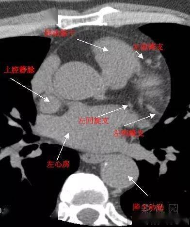 什么情况才需要做冠状动脉CT f332938741794165b04662a31ca357b1.jpeg