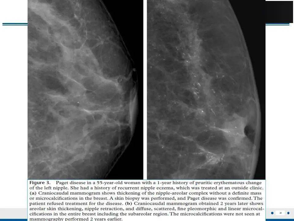【每日一例1205】乳腺paget病(病例精读分析)