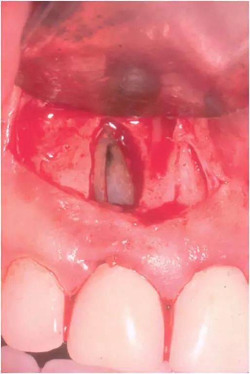 牙根纵裂的诊断——刘学军教授