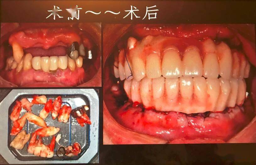 全口无牙颌种植病例-高恩峰博士
