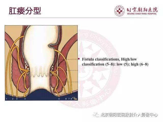 图解肛瘘的解剖和影像诊断