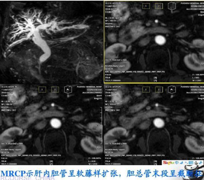 鉴别诊断胰头癌: 胰头部低密度肿物;侵袭壶腹部可见胆总管,胰管扩张