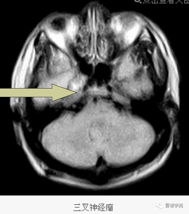 患者头颅mri 强化扫描,可见增粗的三叉神经