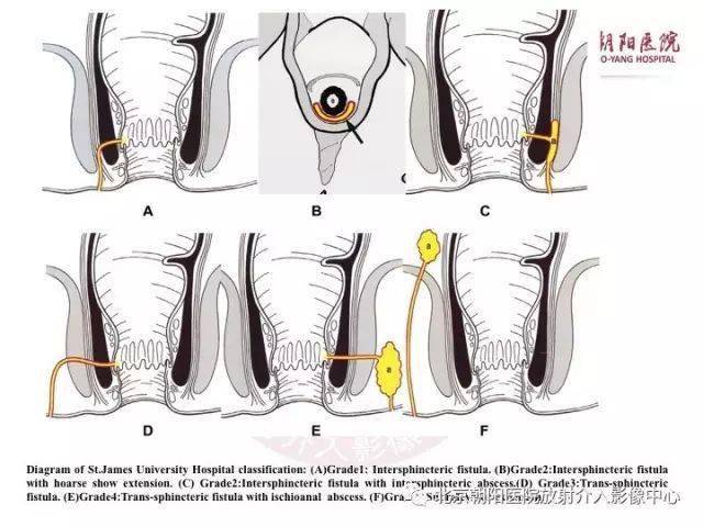 图解"肛瘘"的解剖和影像诊断