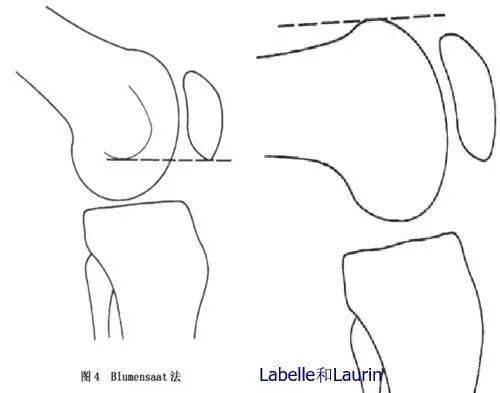 髌股关节解剖及体格检查膝关节疼痛诊断必备