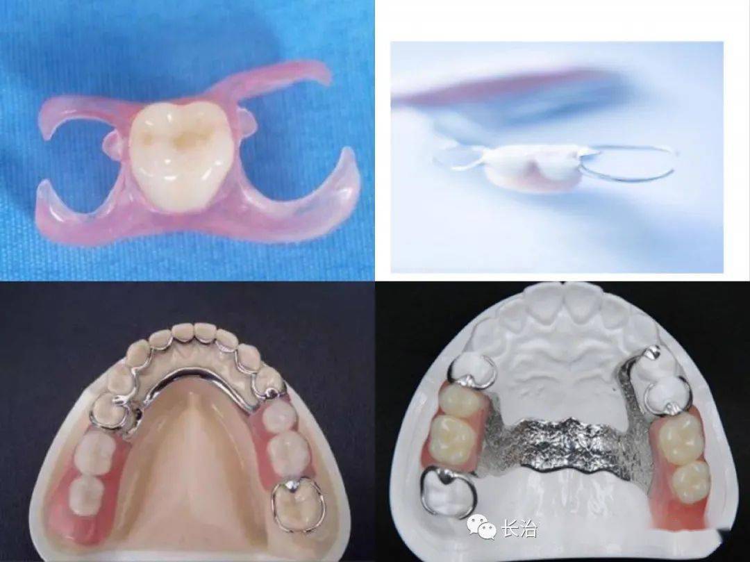 1,可摘局部义齿,就是我们俗称的活动牙固定修复,活动修复,种植修复及