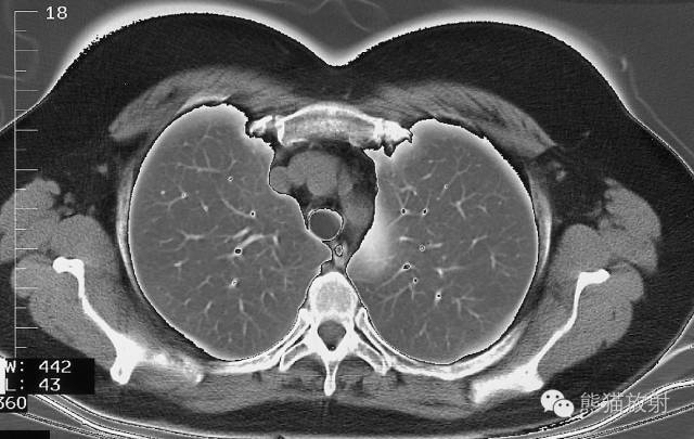 收藏！精美详细的胸部CT断层解剖图（双语）_手机搜狐网