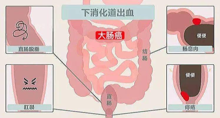 黑色(柏油样)通常和上消化道出血(胃出血,十二指肠出血等)有关.