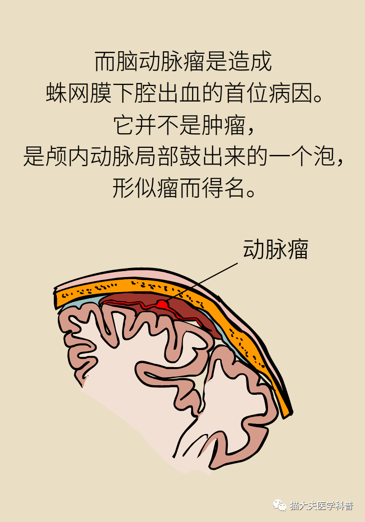 脑动脉瘤之一脑动脉瘤是脑卒中吗