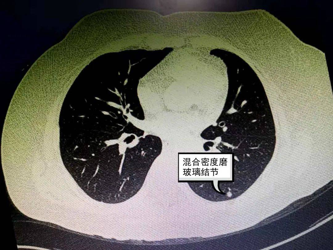 胸中有术丨体检发现肺结节怎么办?