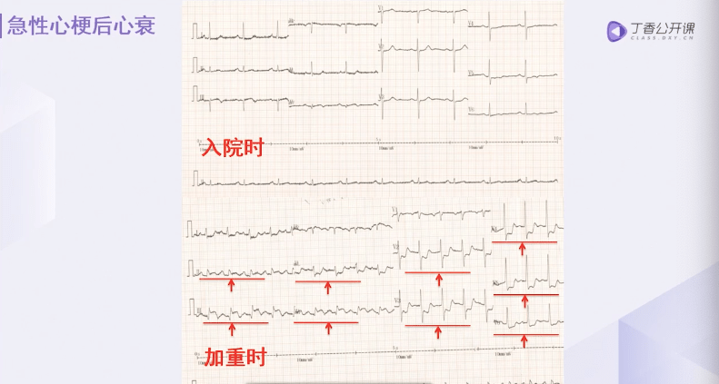 症状  端坐呼吸,咳粉红色泡沫痰提示急性左心衰的典型表现,血压尚可