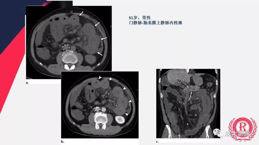 多层螺旋ct诊断急性肠系膜缺血