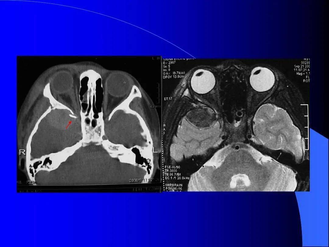 眼眶骨折常见的ct表现