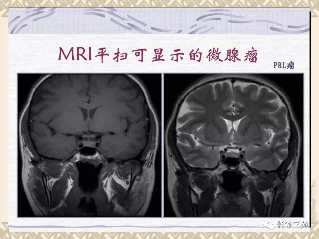 垂体病变的mri诊断