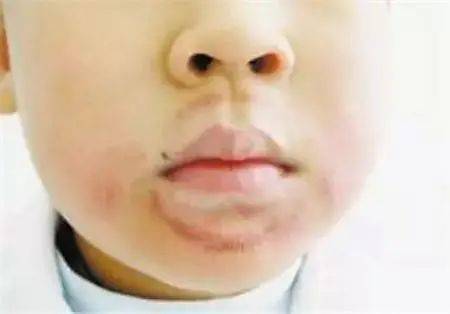 长期危害: 首先,宝宝很可能因为长时间咬嘴唇,出现 唇炎,唇部的粘液腺