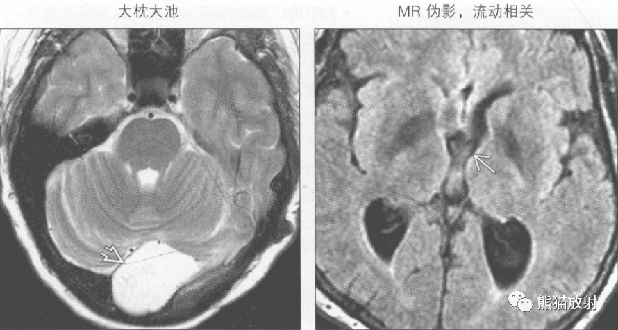 枕大池扩大,与第四脑室或基底池自由交通 颅后窝增大 小脑蚓部正常