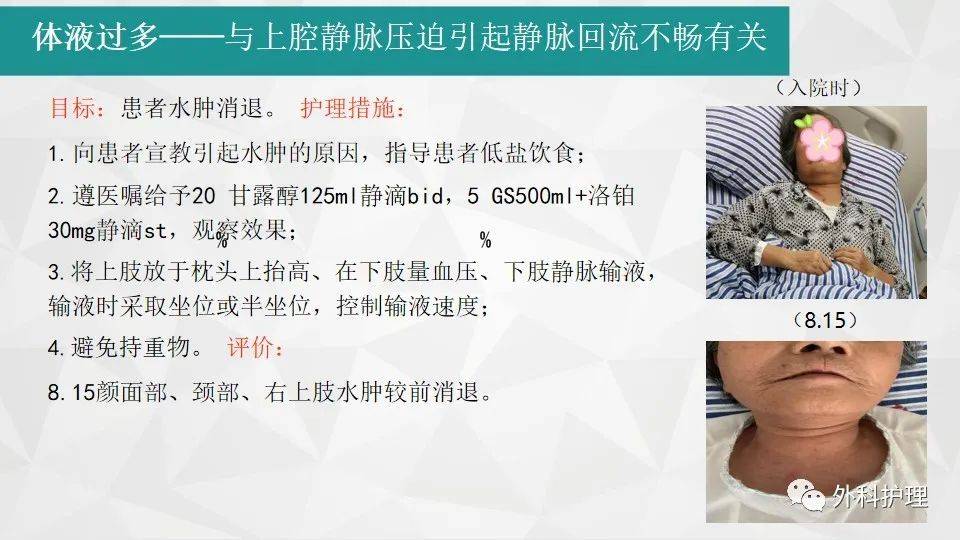 【ppt】1例肺癌合并上腔静脉压迫综合征患者的b超引导下下肢置管护理