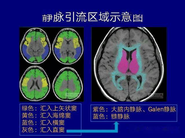 王守森教授:脑静脉与静脉窦血栓形成伴脑出血的ct特征