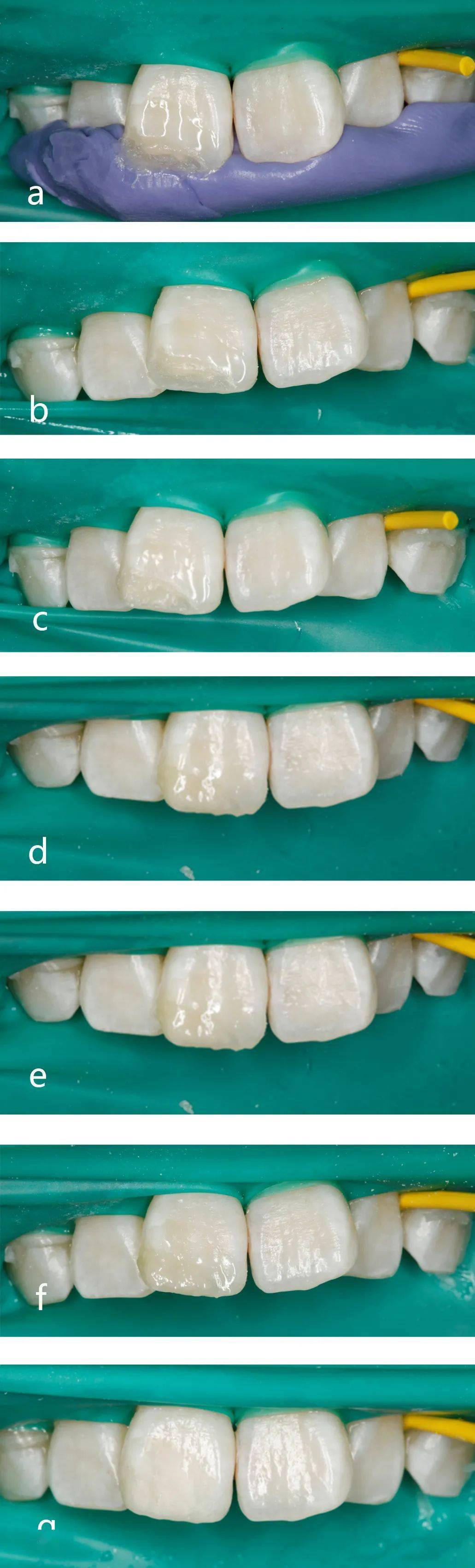 前牙缺损的微创美学树脂直接修复病例