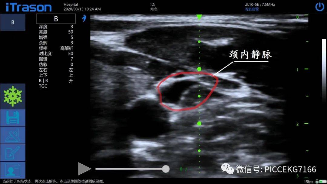 picc堵管后尿激酶溶栓为什么要等30分钟?