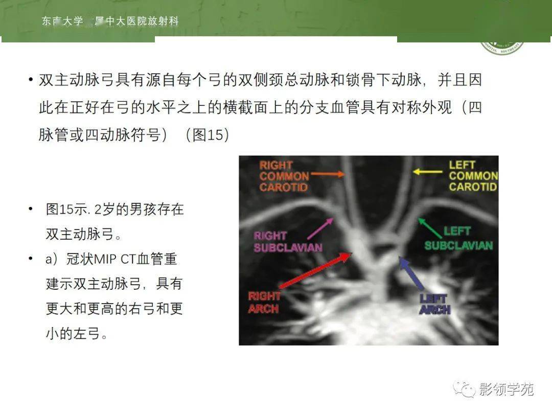 小结:广义的先天性主动脉弓畸形按照是否出现血流梗阻分为梗阻性先天