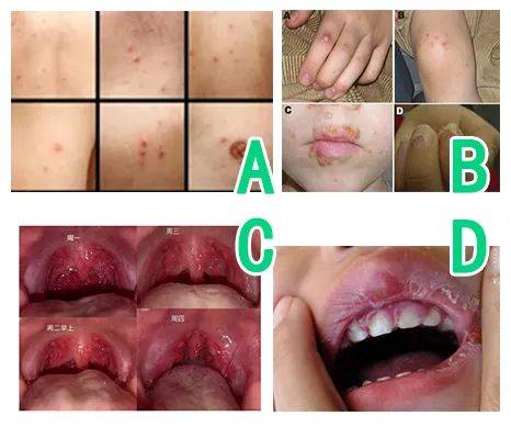 最后给大家出一个看图题: 以下哪个选项是疱疹性咽峡炎的症状呢? 里