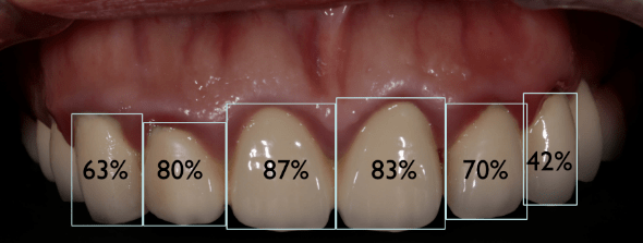 47)边缘不密合伴牙龈红肿,探及大量软垢及少量牙结石,部分修复体崩瓷