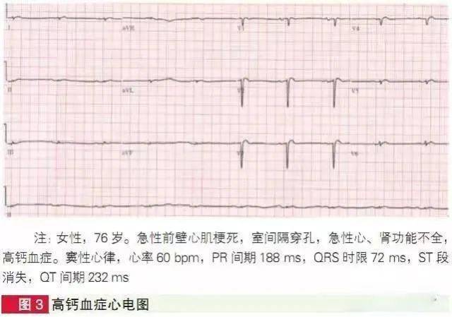 1,心电图表现 主要表现为st段缩短或消失;qt间期缩短,与st段缩短或