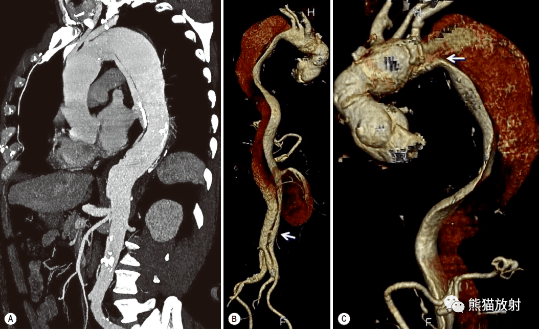 格艾选读丨获得性主动脉异常机理ct表现鉴别诊断