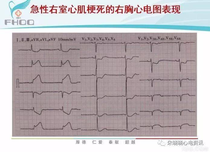 心肌缺血的心电图表现