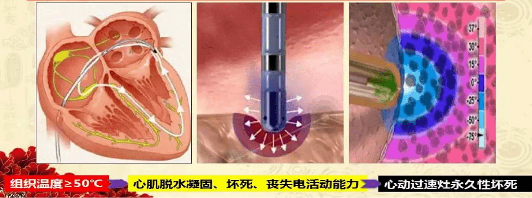 射频消融作为一种全新的心脏介入治疗技术,其安全性如何呢