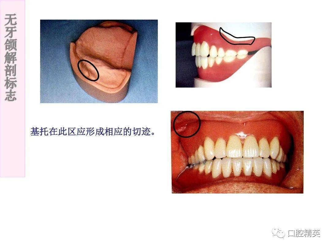 无牙颌解剖标志_手机搜狐网